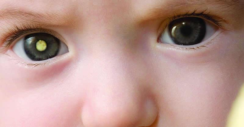 O que causa o Retinoblastoma?